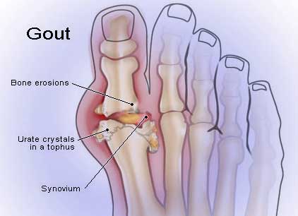 دواء يوريك بيور Uricpure