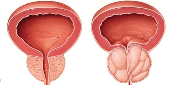 علاج التهاب البروستاتا المزمن بالثوم