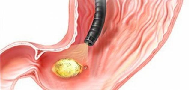 علاج التهاب المعدة