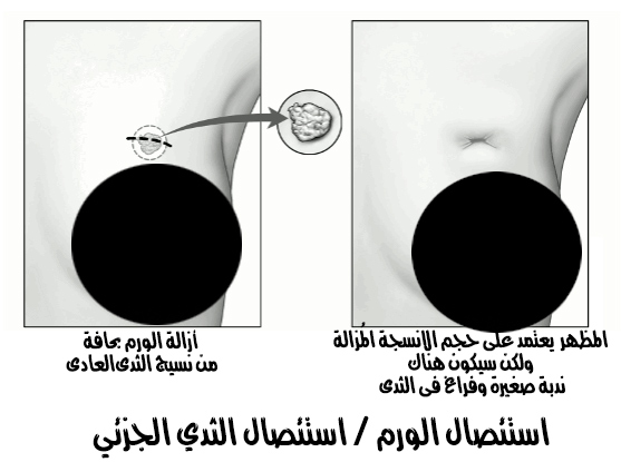 جراحة الحفاظ على الثدي