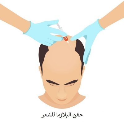 حقن البلازما للشعر