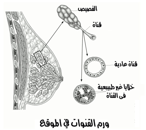 ورم القنوات في الموقع