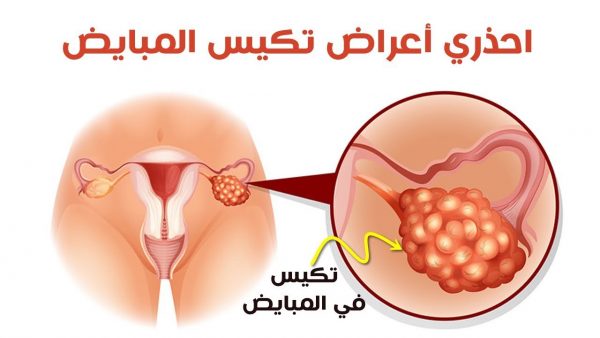 يزيد الخصوبة للنساء مع متلازمة تكيس المبايض