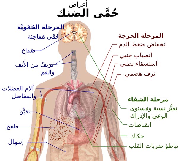 حمى الضنك Dengue fever