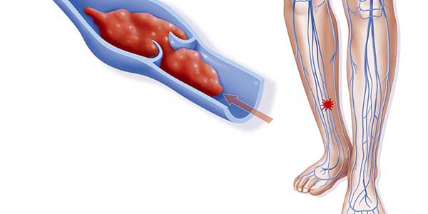 علاج جلطة الساق بالأعشاب