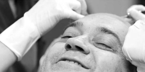 مميزات وعيوب عمليه زراعه الشعر في جده 