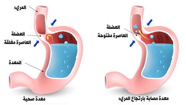 اسباب ارتجاع المرئ