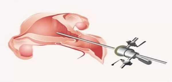 تجربتي مع منظار الرحم التشخيصي