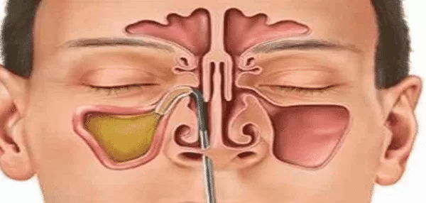 عملية الجيوب الأنفية بالمنظار