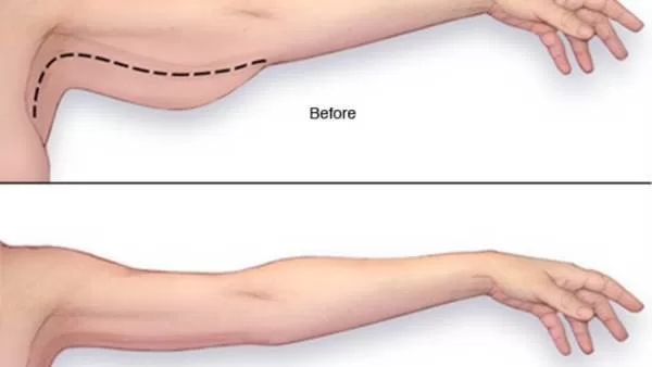 تجربتي مع شفط دهون الذراعين