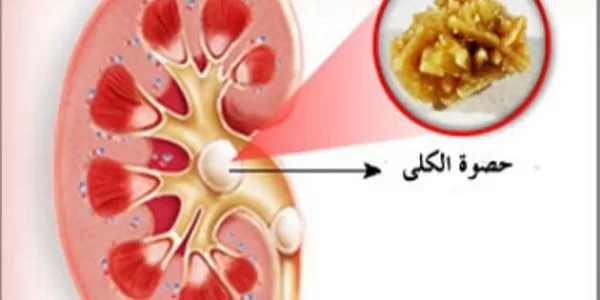 تجربتي مع رمل الكلى